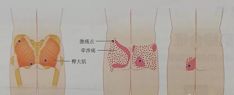 收藏综合征,男性骨盆疼痛综合征