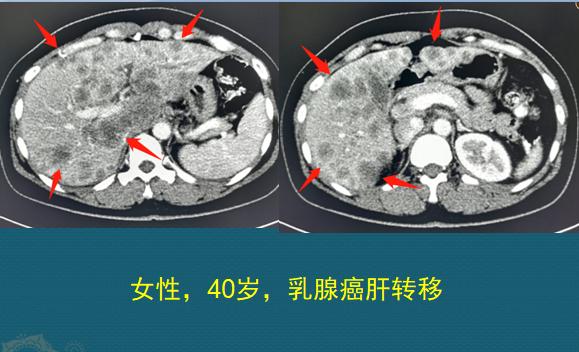 分享癌症患者康复,肿瘤病人的分享