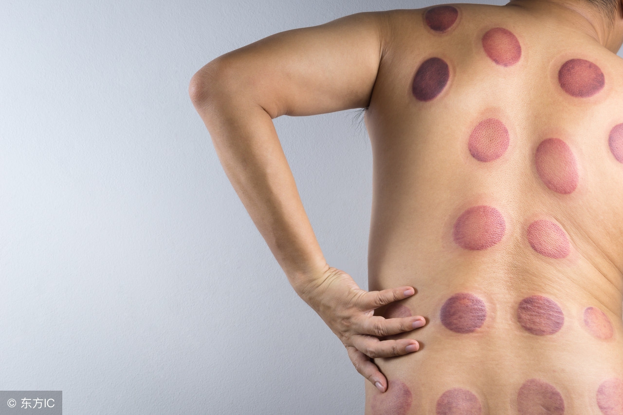 拔罐的知识你知道多少