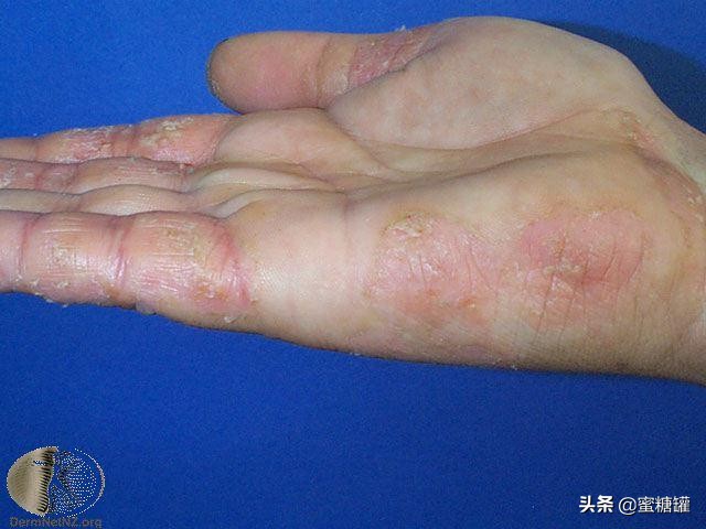 异位性湿疹吃什么药好,皮肤病湿疹痒吗