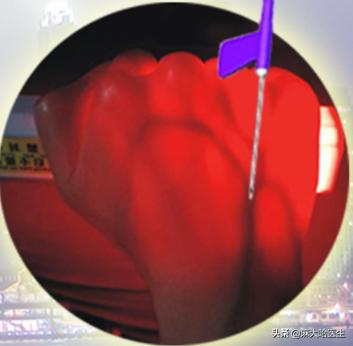 静脉扎针不回血是怎么回事,静脉针不好扎怎么办