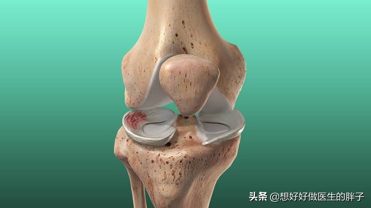 半月板缝合术后膝盖肿胀怎么消除,半月板缝合术后肿胀正常吗