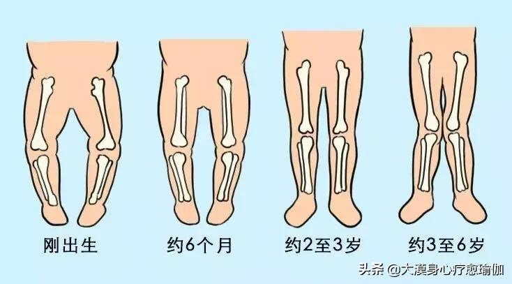 穿纸尿裤对孩子腿型有影响吗,小时候腿不正长大后会矫正吗