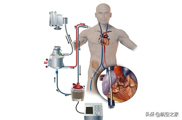 icu设备要多少钱一台,ecmo人工膜肺机国产化