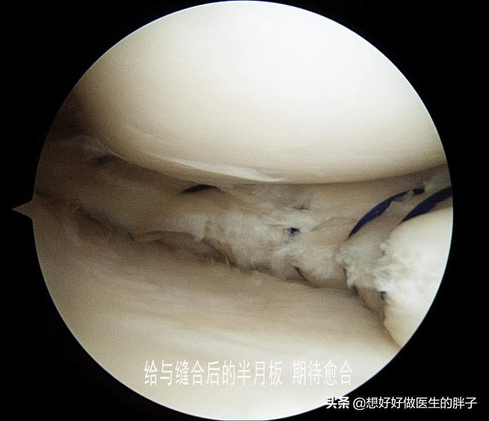 足球运动员为什么没有半月板,足球到底伤半月板吗