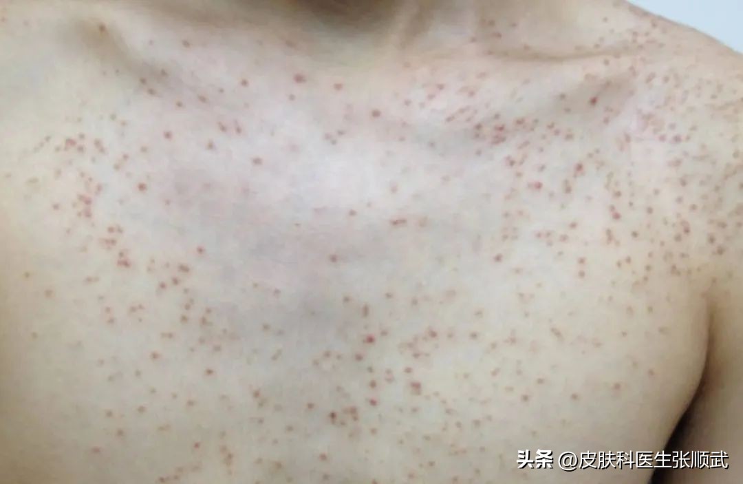 螨虫毛囊炎用什么药物治疗,毛囊炎用什么药治疗最好