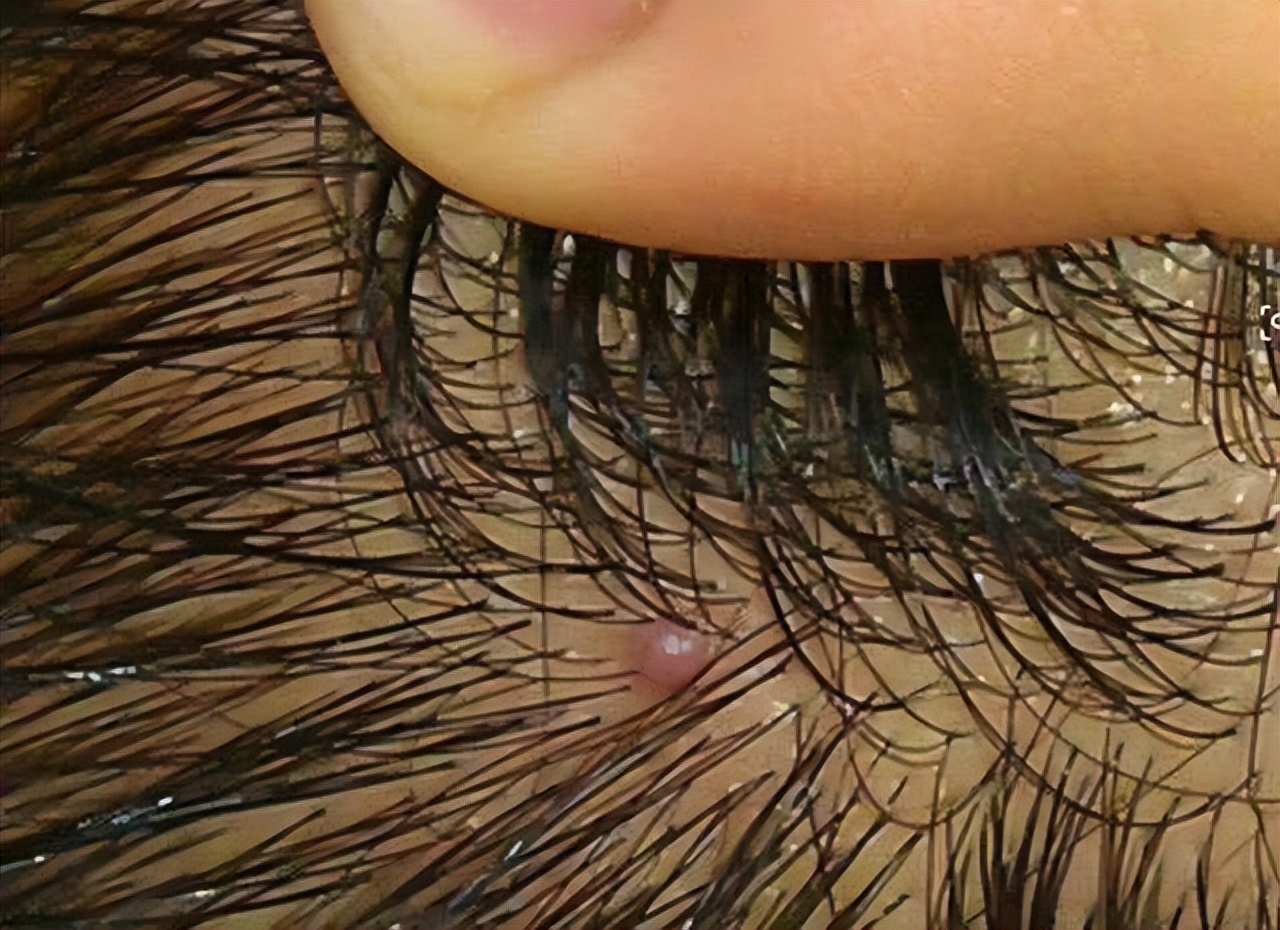 头皮上长疙瘩和脓包是怎么回事,头皮总是长疙瘩或脓包是什么原因