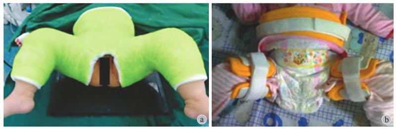 pavlik吊带需要手法复位吗,pavlik吊带戴了有什么后遗症