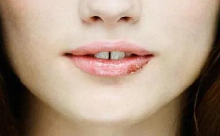 嘴巴起泡可能是单纯的疱疹病毒,得了疱疹嘴巴里全是泡该怎么办