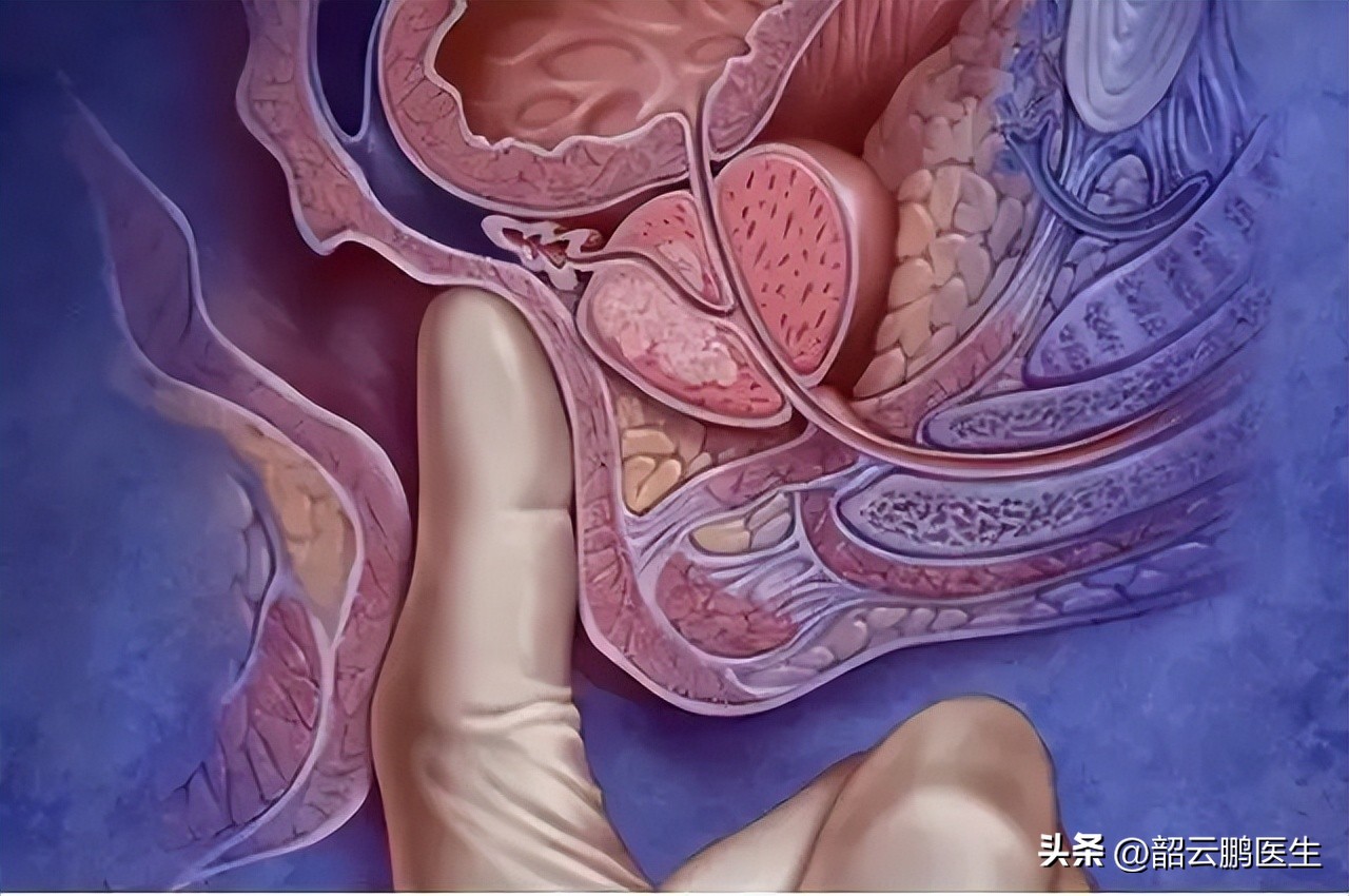 psa诊断早期前列腺癌的准确率,筛查前列腺psa需要空腹吗