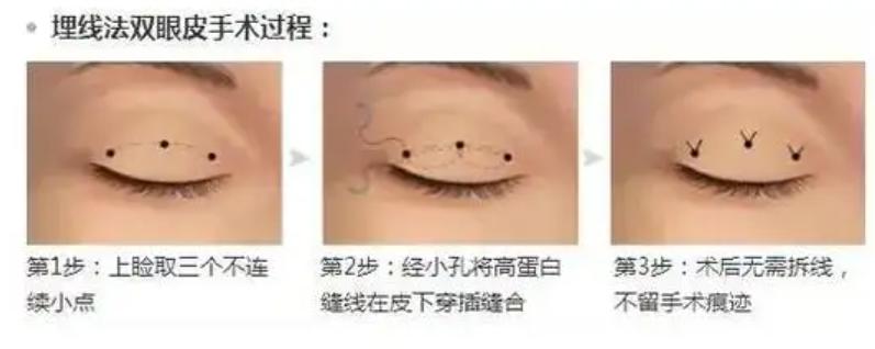 双眼皮做什么术式的好,微创双眼皮术式