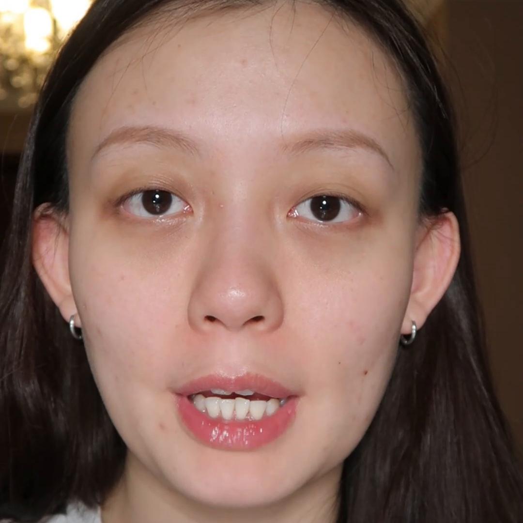 痘肌祛闭口的最好方法,闭口混合痘肌如何护肤