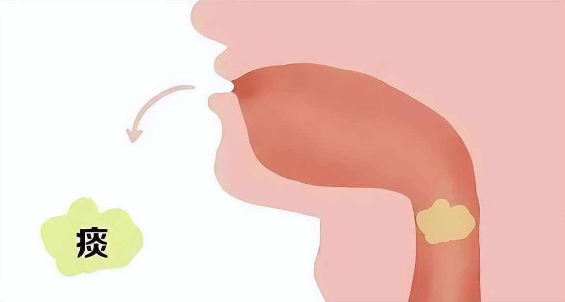 痰的颜色代表肺部健康状况,怎么区分痰是从肺部来的