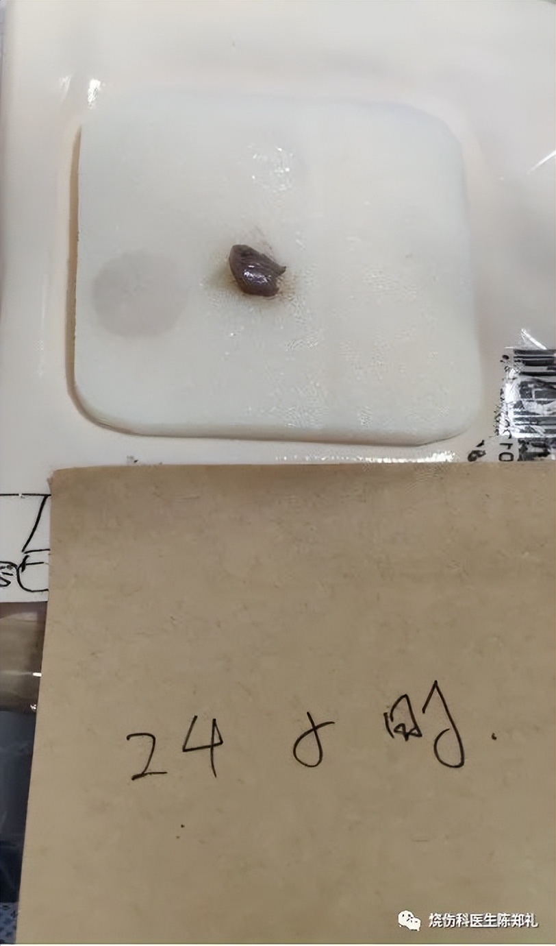 慢性创面患者的敷料运用及选择,创面换药敷料的选择