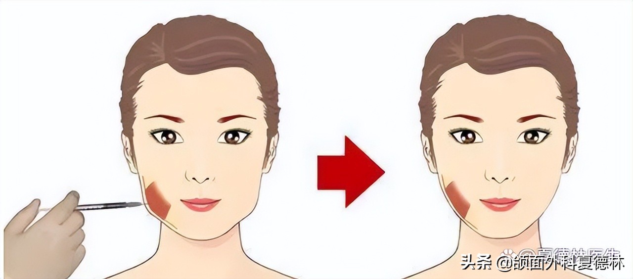 瓜子脸发腮了怎么办,为什么人长大会发腮