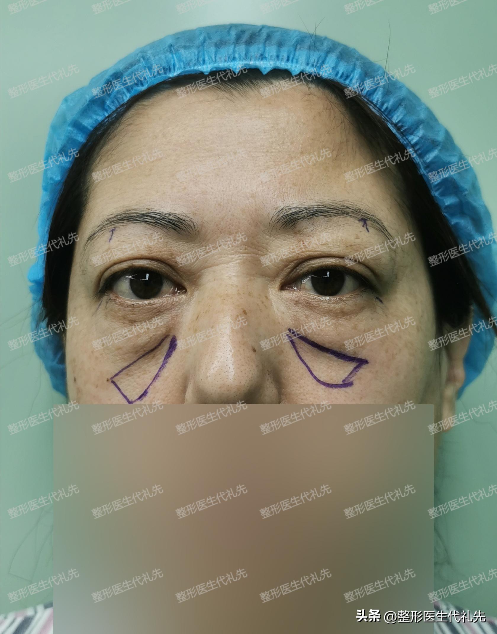 祛眼袋手术后有细纹会慢慢恢复吗,祛眼袋两年后眼睛凹陷怎么办