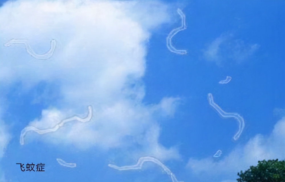 眼前只有一个小黑点算是飞蚊症吗,眼前有飞蚊症怎么办