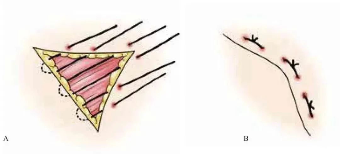 3分钟get:真正的外科缝合秘籍