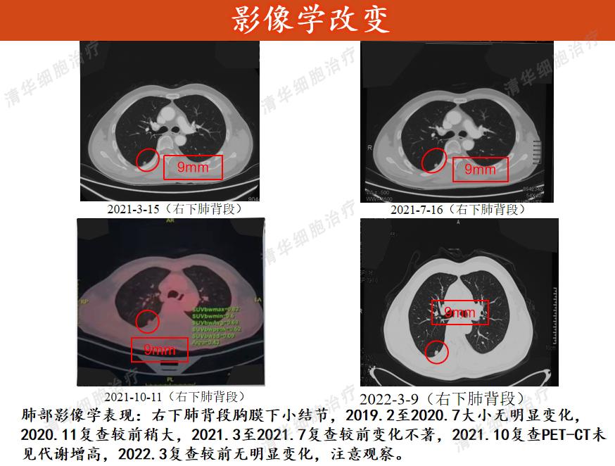 患癌20年经历2次转移最终抗癌成功,肾癌10年后发生转移