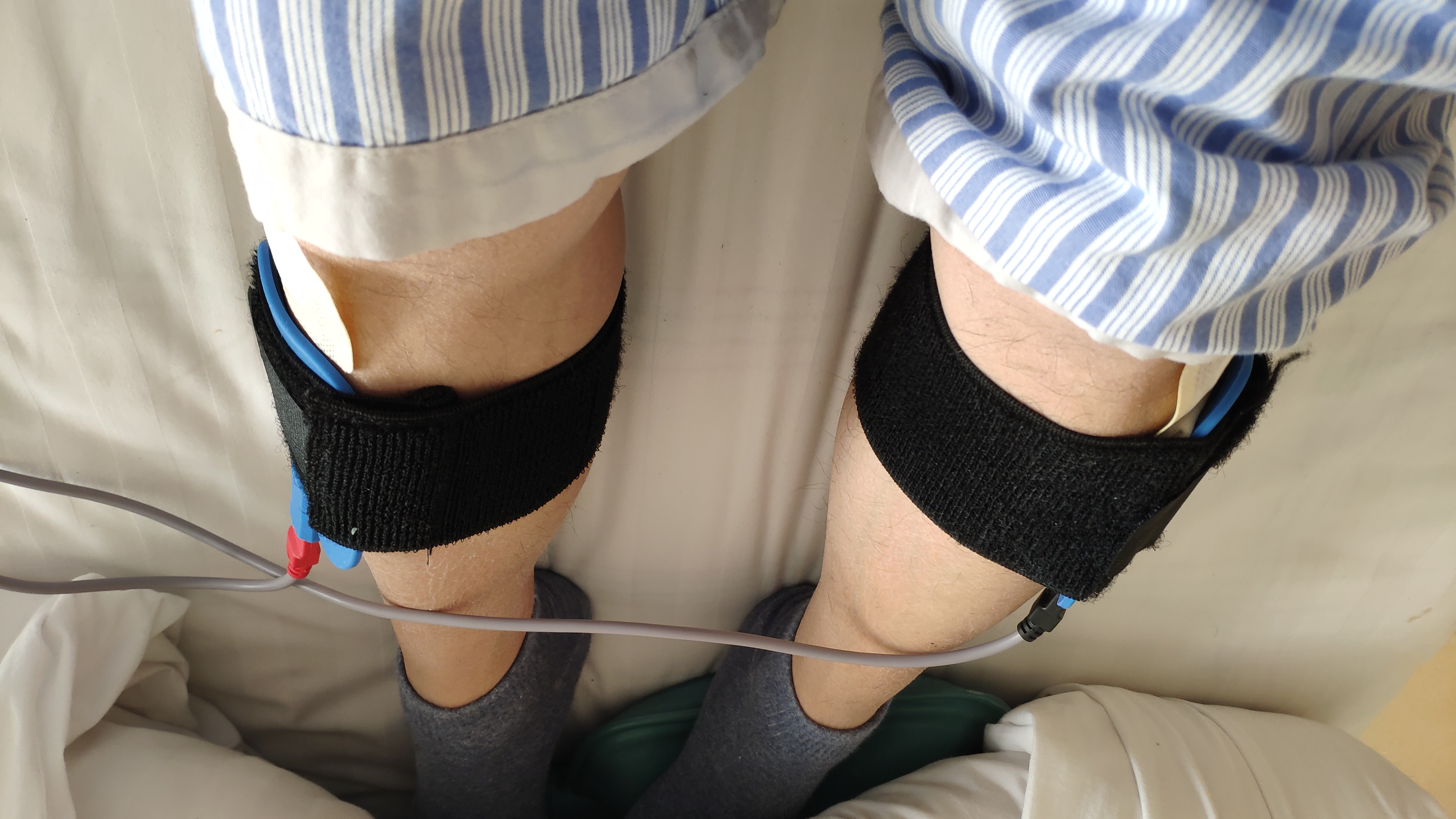 痔疮切除术手术记录,痔疮手术过后家里换药全过程