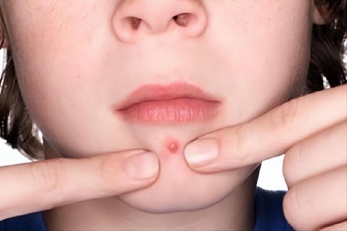 痘痘增生疤痕疙瘩怎么能彻底消除,如何分辨凸起的是痘痘还是疤痕