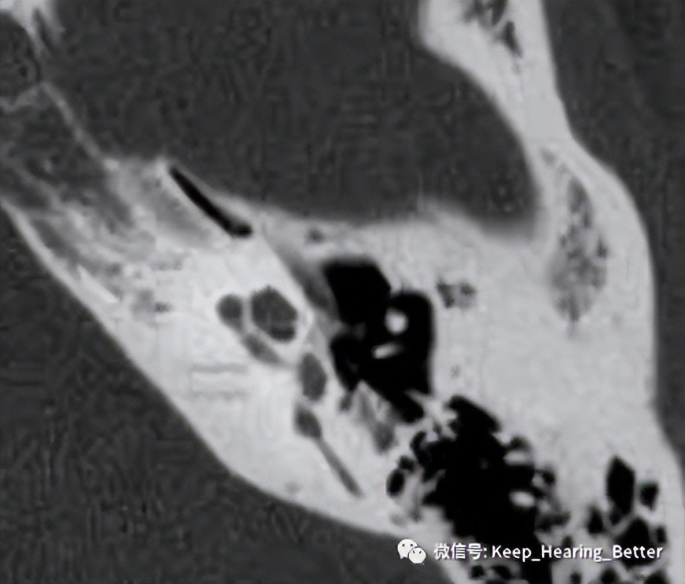 南昌大学二附院耳喉科,耳膜硬化症是什么样子