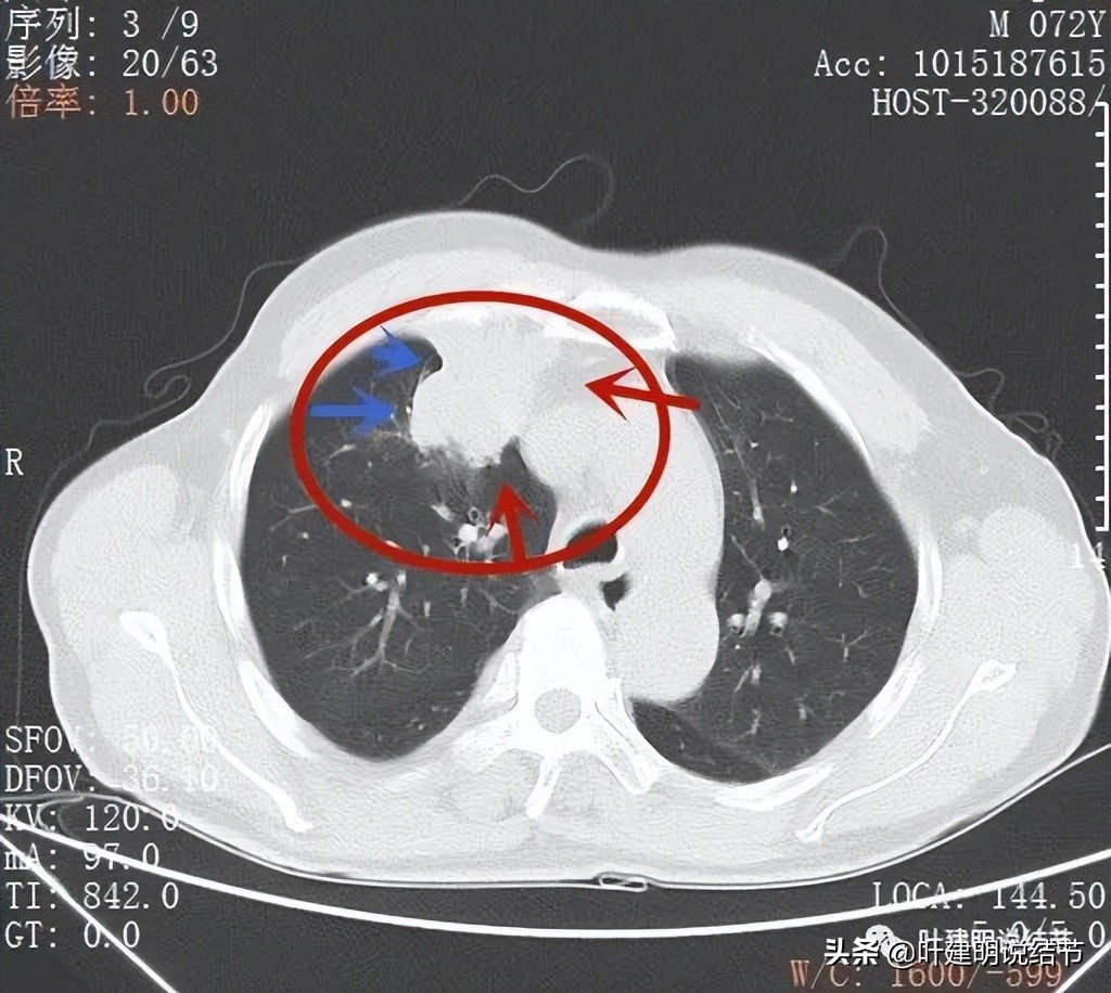 经验：肺占位超6厘米，不是癌还会是什么？临床上仍得多个心眼