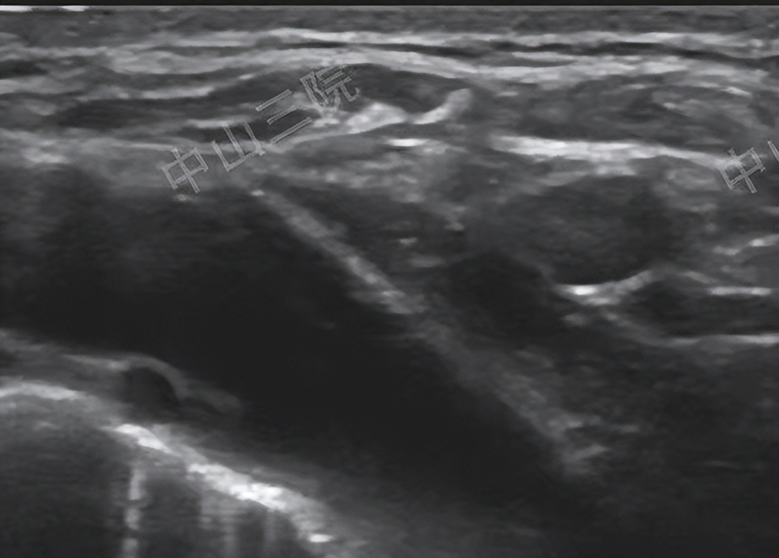 甲状腺癌做过碘131治疗还能活多久,甲状腺癌做碘131后变甲减了怎么办