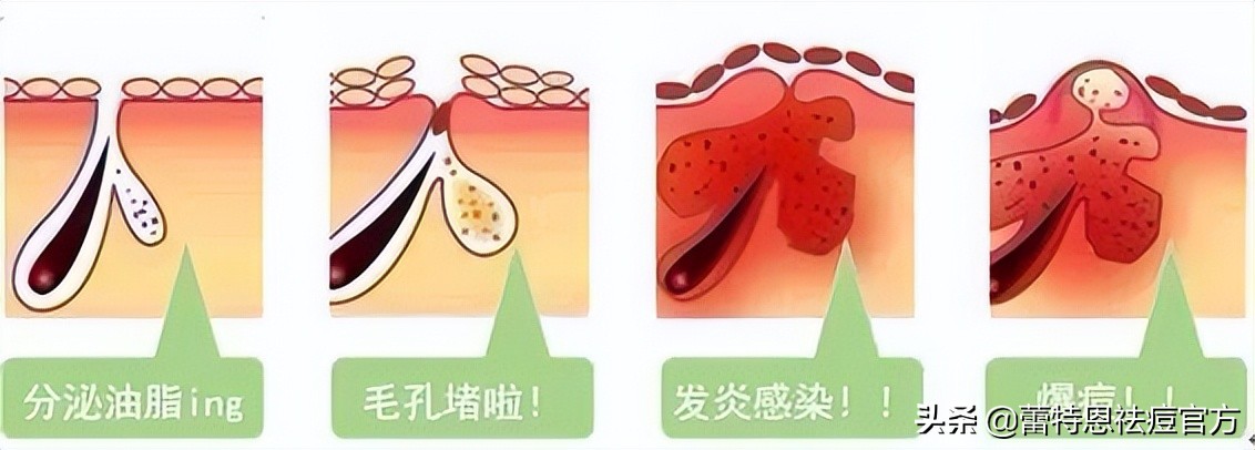 不知道自己长的什么痘,不知道自己长痘痘的原因