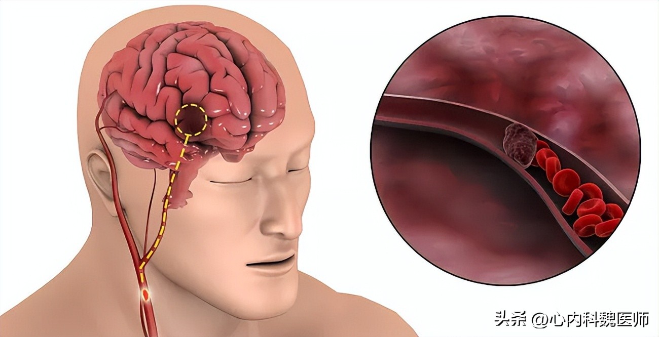 老年人房颤引起中风严重吗,缺血性中风和房颤中风区别
