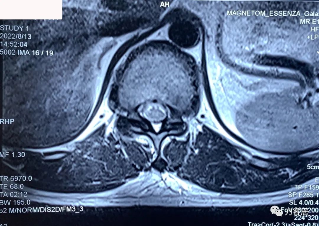 良性单侧下肢肌萎缩,双下肢肌萎缩