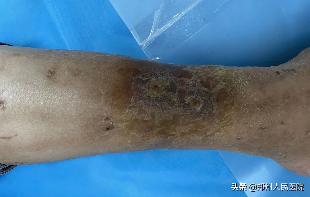 磕碰伤口化脓怎么处理最好的方法,烂腿伤口怎么治疗最好