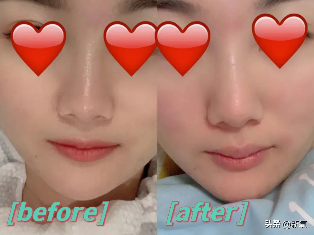 嘴唇薄变丰满,嘴唇变凸变丑怎么办