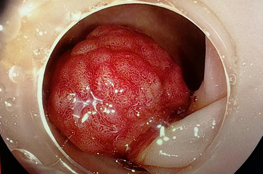 大便带血错当痔疮！肠镜下“摘”掉草莓大小息肉