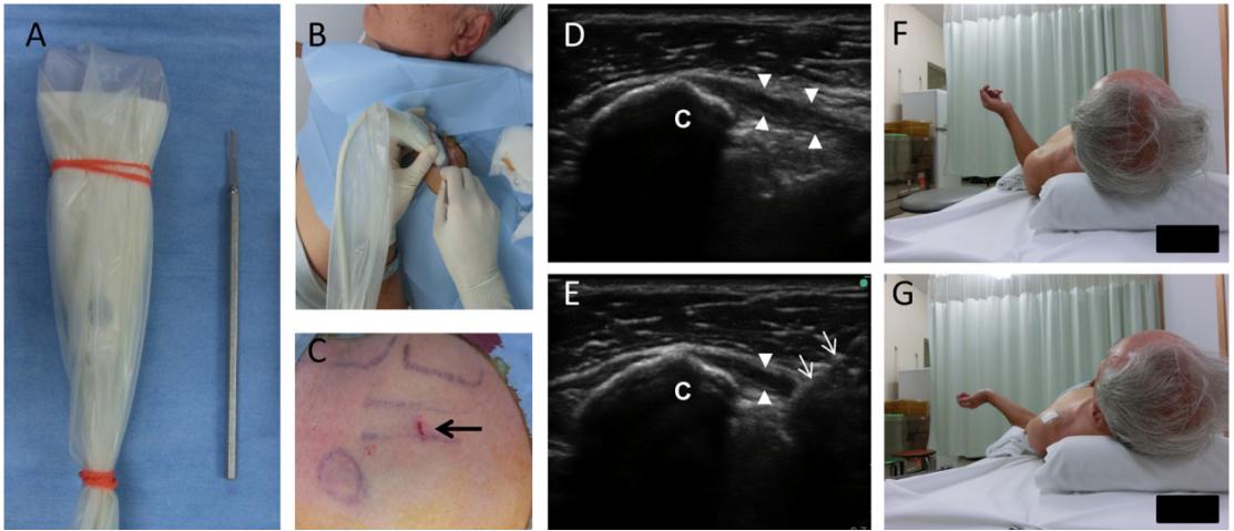 肩关节周围炎超声波治疗如何操作,超声引导下肩关节疼痛治疗