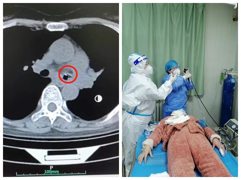 西安市北方医院:患者支气管里发现注射器针头，医生巧施异物钳顺利取出