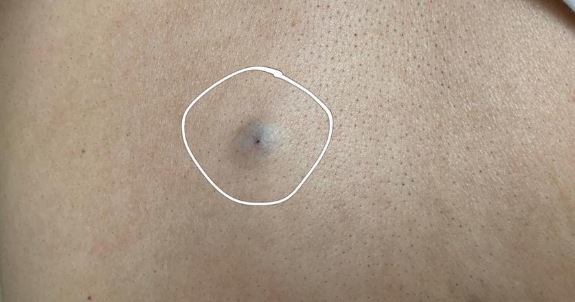 脖子和腋下的小肉粒可以揪了吗,脖子上的小肉粒揪掉后会怎样