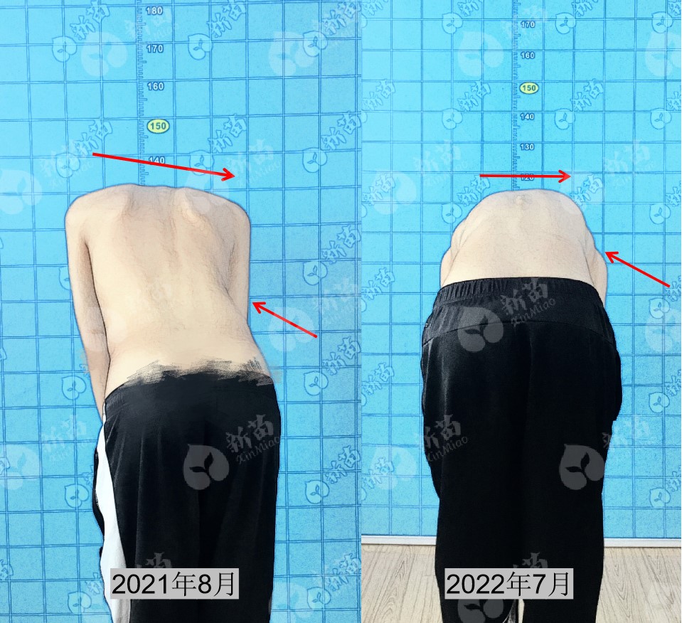 青少年脊柱侧弯如何自我矫正,青少年脊柱侧弯自我矫正