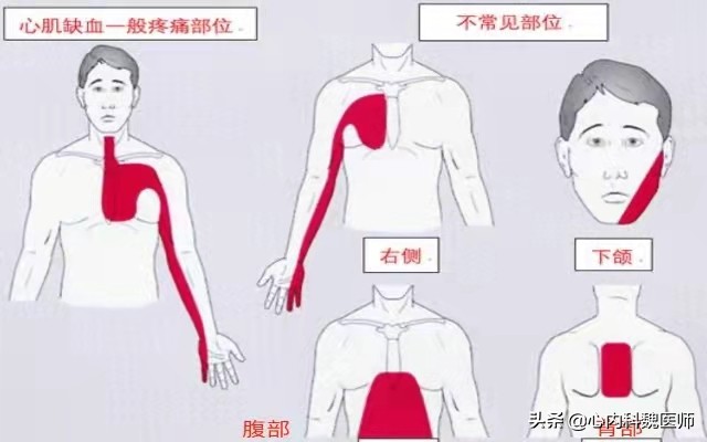 心肌缺血吃什么药效果更好,心肌缺血吃什么药效果比较好