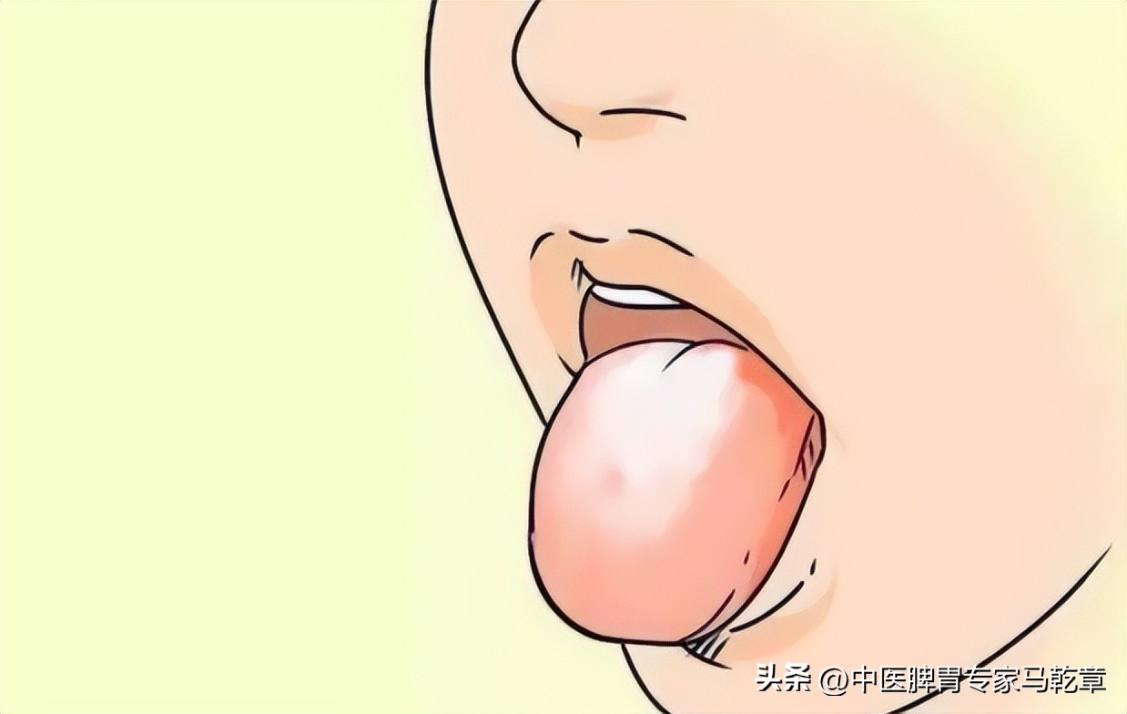 有萎缩性胃炎舌苔发黄是怎么回事,萎缩性胃炎舌苔表现