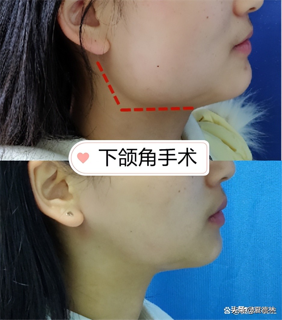 削骨和磨骨区别后遗症,削骨和磨骨的区别和危害