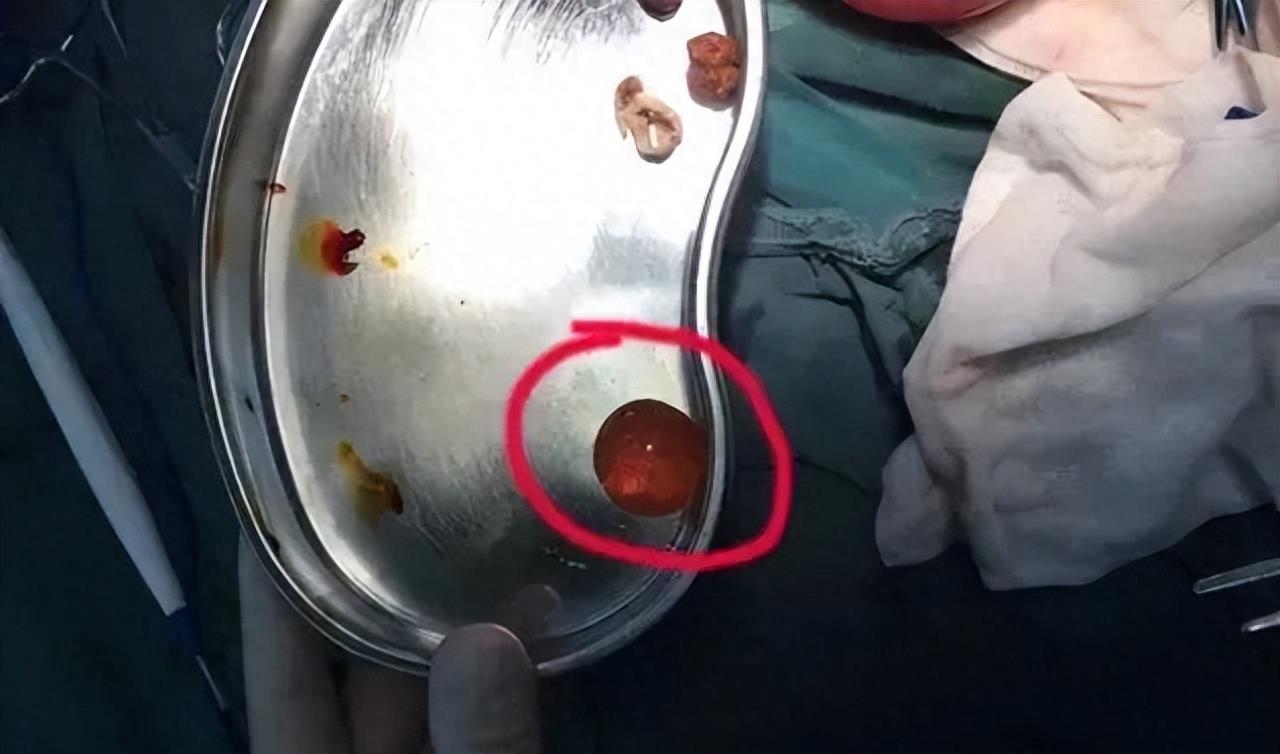 六岁男童腹痛呕吐,4岁男孩突然呕吐不止