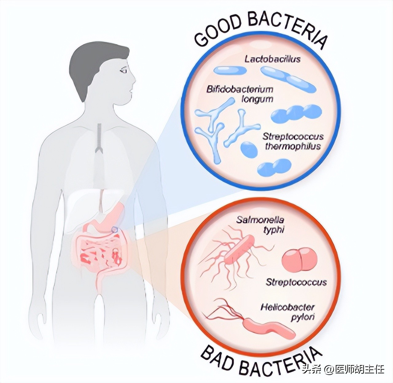 为什么肠道会长息肉,为什么肠道容易长息肉