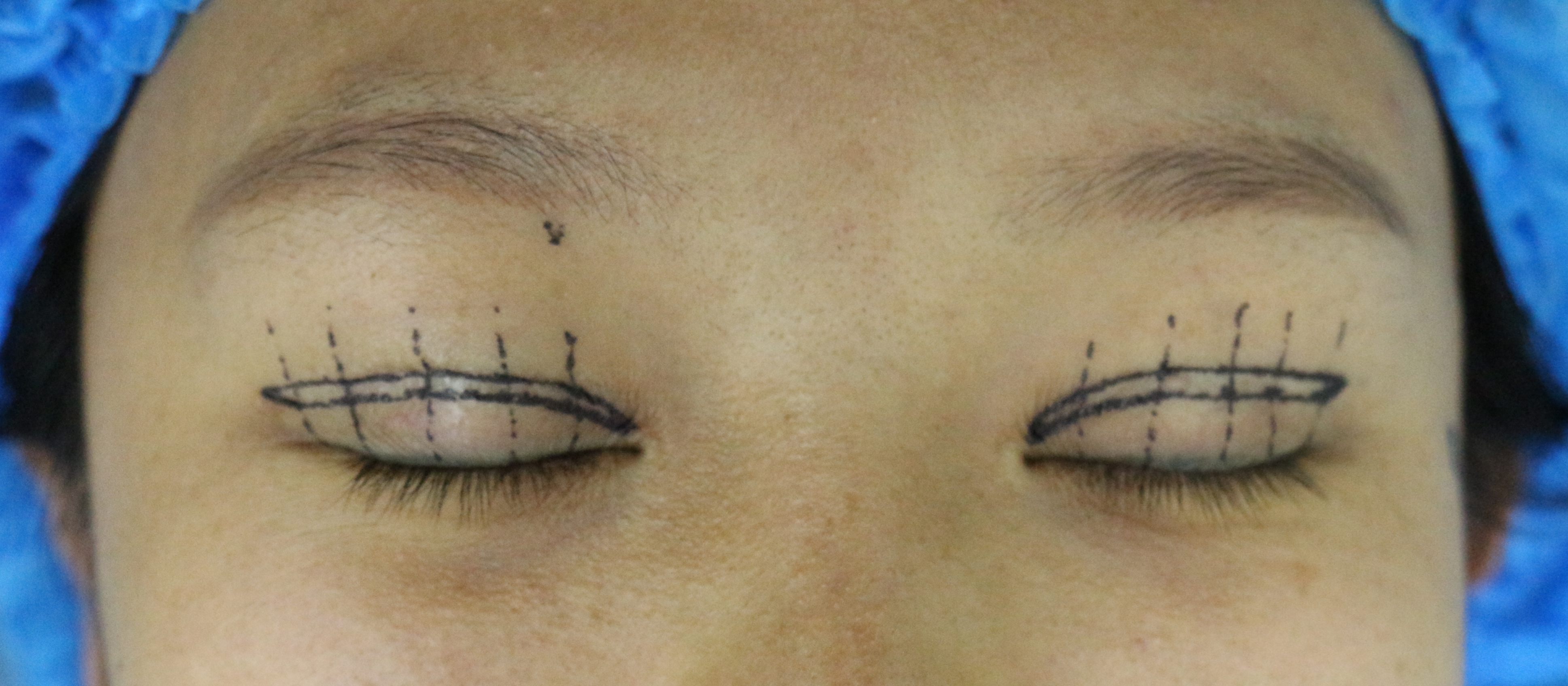 双眼皮修复新乡,姑娘眼部整形后双眼皮变三眼皮