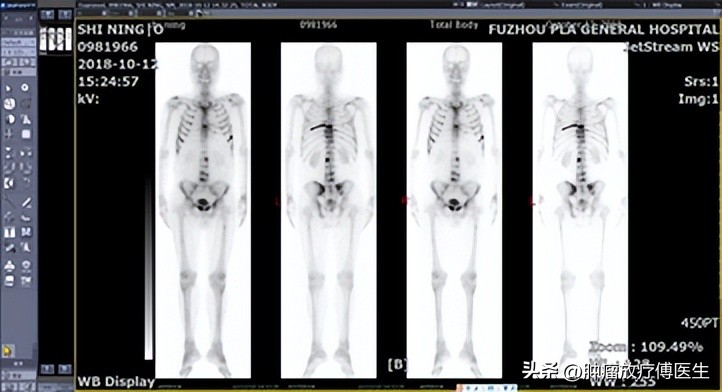 前列腺癌psa8,前列腺癌内分泌治疗psa降低至2.75