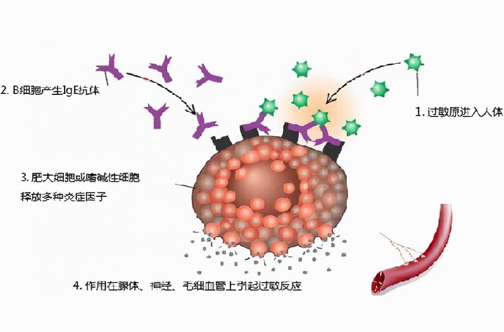 一到冬季鼻炎就严重怎么办,为什么过敏性鼻炎在夏季容易发作