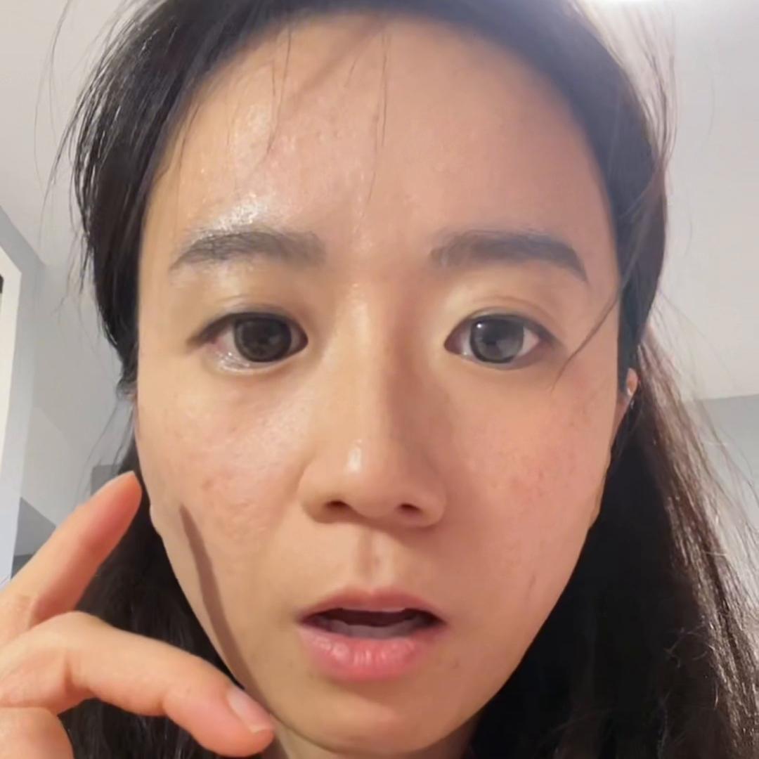 姐妹治好痘痘的视频,姐妹们广州治疗痘痘