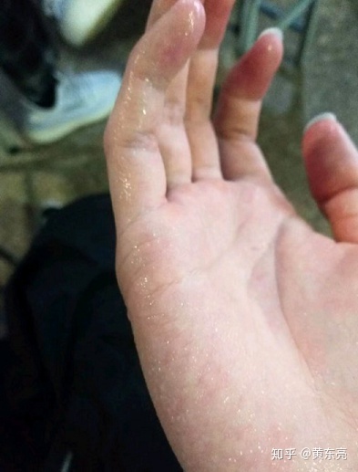 怎样才能有效的治疗手汗症,怎样治疗汗手汗脚