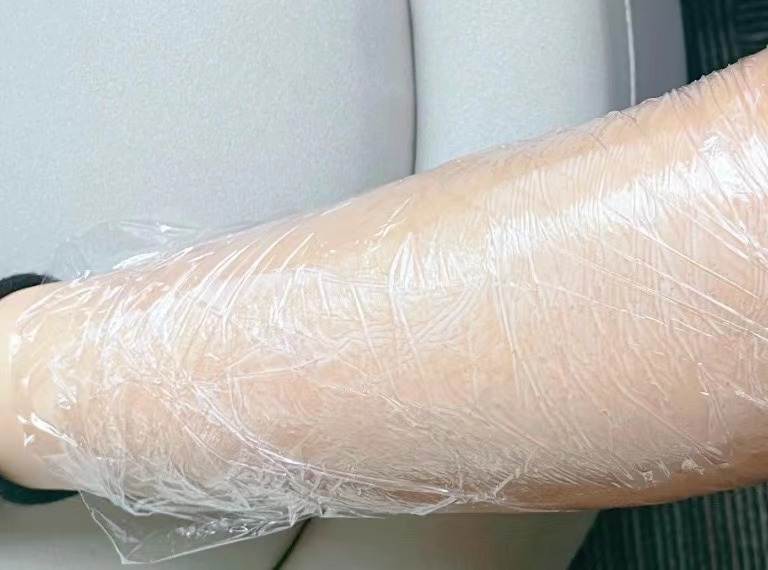 肥胖纹目前最好的去除办法,淡化肥胖纹修复肥胖纹