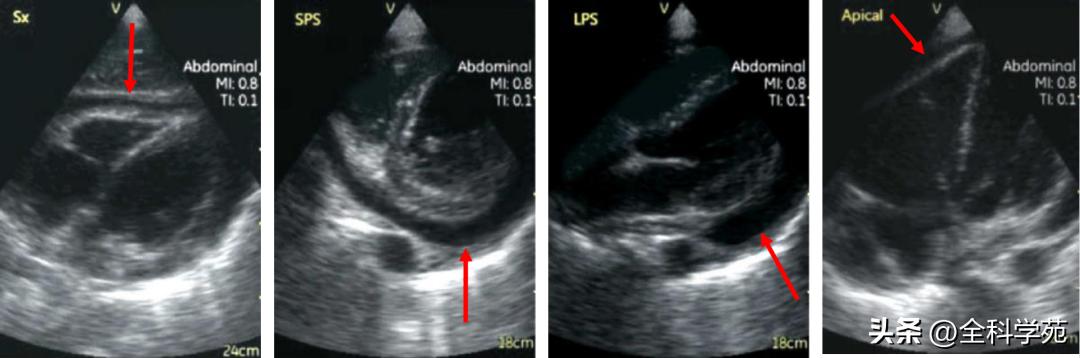 心电图qrs时限超宽是什么引起的,心电图qrs波呈m型见于什么疾病
